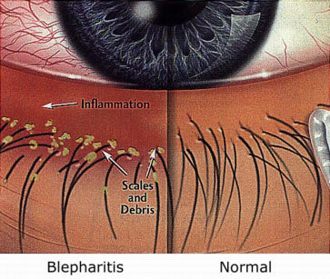 Blepharitis-compare