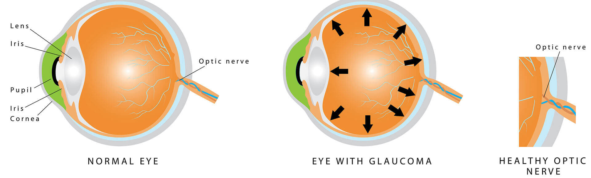 Eye with Glaucoma